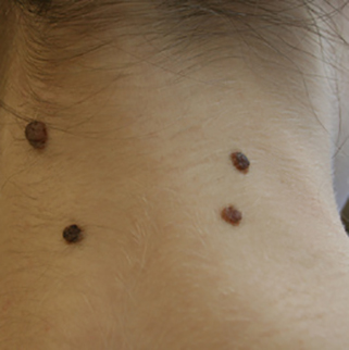 удаление родинок