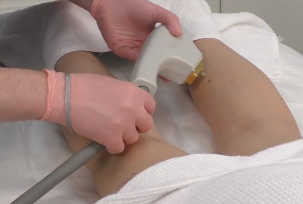  Удаление пигментных пятен