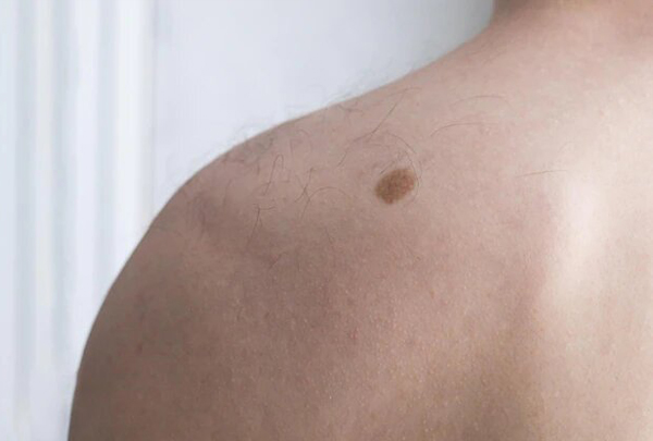  Удаление пигментных пятен